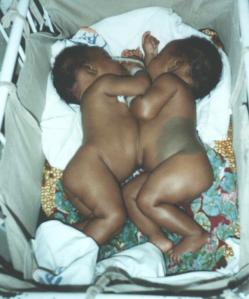 Siamese Twins, Ghana before separation