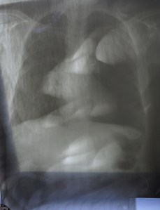 X-ray developed manually